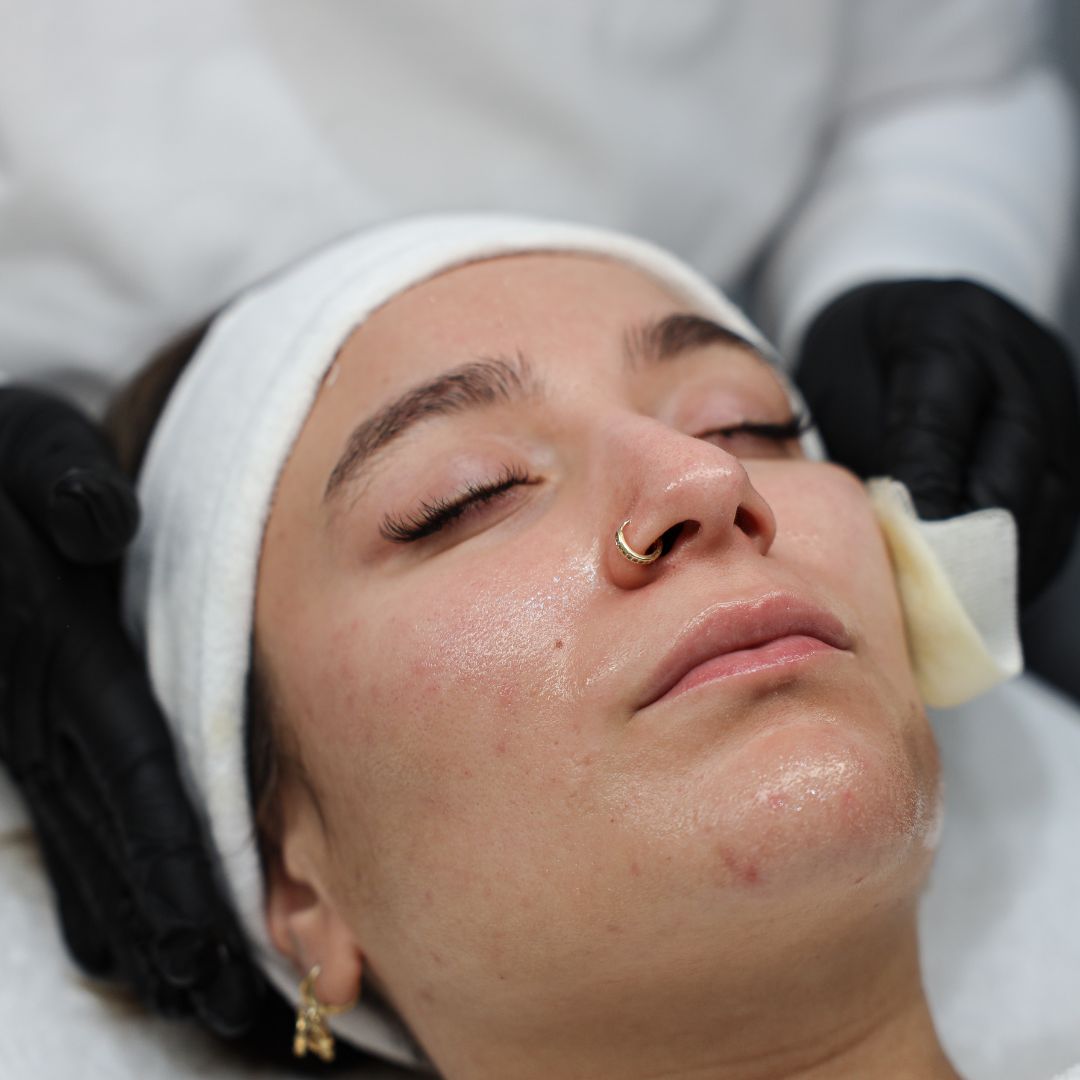 Chemische peeling huidvernieuwing mesopeel - mesoestetic - Rotterdam